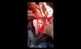 Prélèvement du coeur et du foie avec une seule cardioplégie rétrograde.