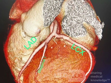 Angiographie Coronarienne Multicoupe