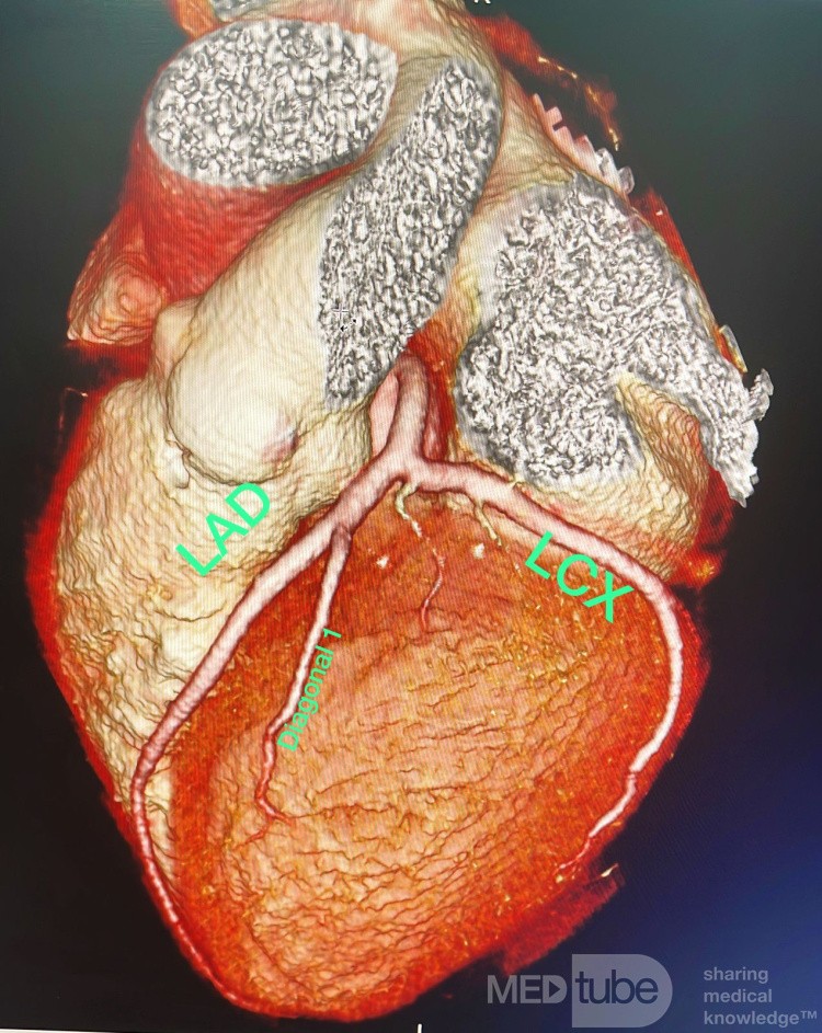 Angiographie Coronarienne Multicoupe