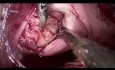 vNOTES Myomectomie | Chirurgie endoscopique transluminale d'orifice naturel transvaginal pour enlever le fibrome