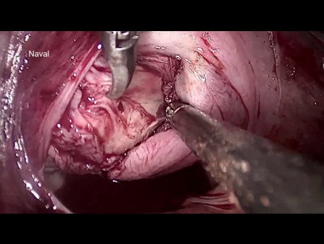 vNOTES Myomectomie | Chirurgie endoscopique transluminale d'orifice naturel transvaginal pour enlever le fibrome
