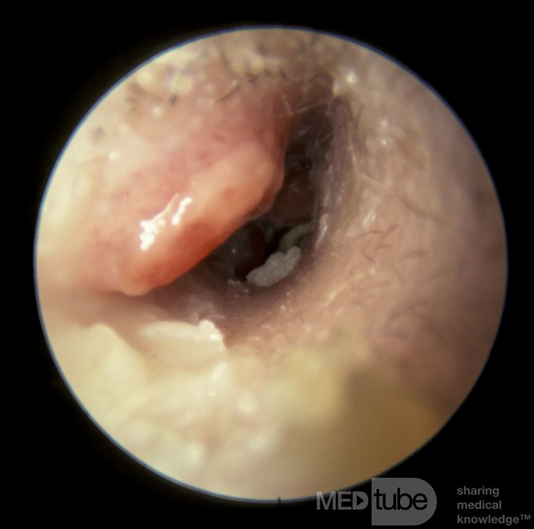 Mastoïdite s'écoulant dans le canal externe [oreille droite]
