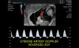 Doppler Anormal dans un Cas de RCIU