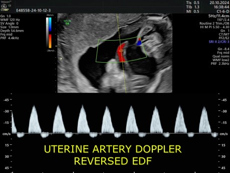 Doppler Anormal dans un Cas de RCIU
