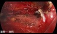Chirurgie Thyroïdienne Endoscopique Trans-Sous-Clavière à Double Abord (partie 1)