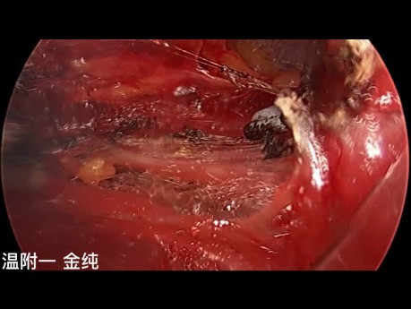 Chirurgie Thyroïdienne Endoscopique Trans-Sous-Clavière à Double Abord (partie 1)