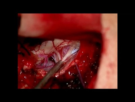 Méningiome au rachis cervical C1