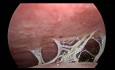 Carcinose - Adénocarcinome Gastrique