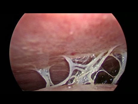 Carcinose - Adénocarcinome Gastrique