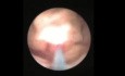 Lithotripsie extracorporelle par ondes de choc - Empierrement urétéral