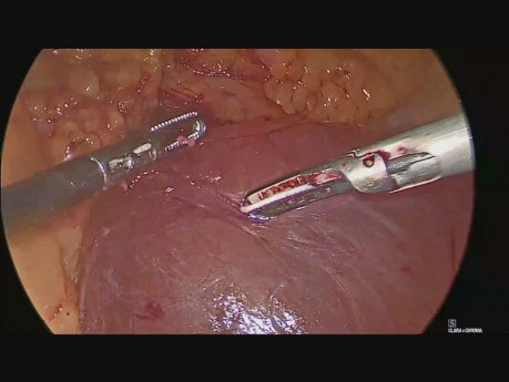 Excision d'un gros kyste mésothélial au niveau de l'angle duodénojéjunal par laparoscopie