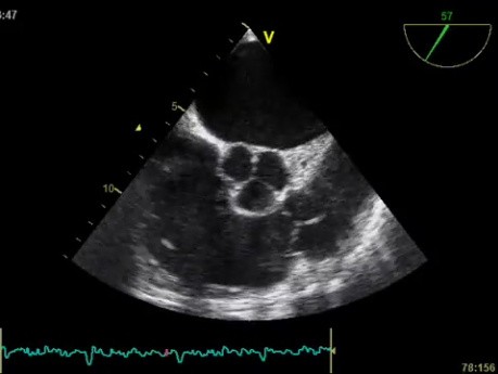L'échocardiographie trans-oesophagienne - La valve pulmonaire