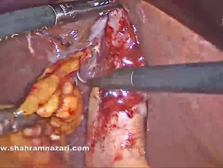 Dissection Artérielle dans un Cas de Vésicule Biliaire Fibrotique Chronique