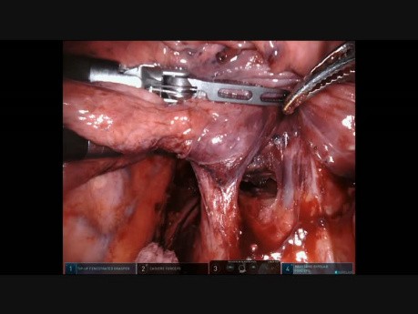 Pneumonectomie robot-assistée - Cancer du lobe pulmonaire inférieur