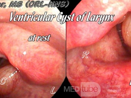 Kyste sacculaire au repos et en phonation 
