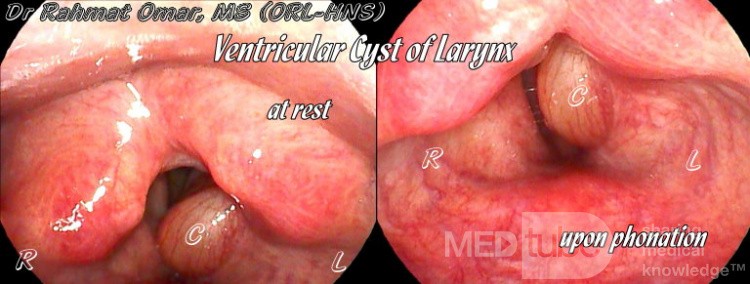 Kyste sacculaire au repos et en phonation 