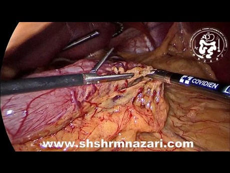 Sleeve gastrectomie et cholécystectomie laparoscopique concomitantes