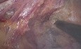 EMT Laparoscopique + Anastomose Colorectale Ultra-Basse
