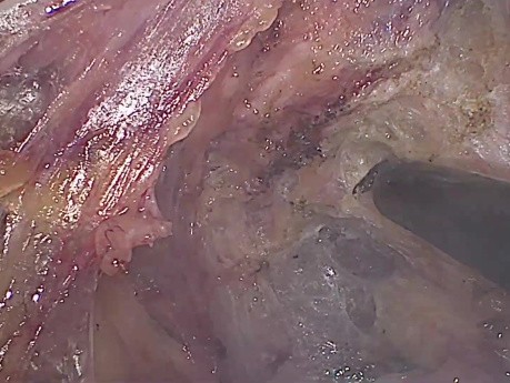 EMT Laparoscopique + Anastomose Colorectale Ultra-Basse