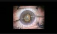 Chirurgie de la cataracte par phacoémulsification, pupille étroite, l'anneau de Malyugin.