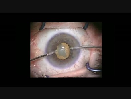 Chirurgie de la cataracte par phacoémulsification, pupille étroite, l'anneau de Malyugin.