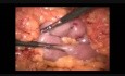 Mini bypass gastrique par voie laparoscopique