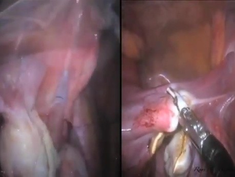 Cholécystectomie avec Hystérectomie Totale Concomitante et Salpingo-Ovariectomie Bilatérale LESS