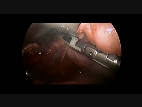 Résection thoracoscopique d'un ganglioneuroblastome chez un enfant d'un an