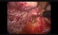 Exploration laparoscopique du canal cholédoque (post-cholécystectomie)