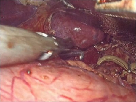 Chirurgie laparoscopique pour le syndrome du ligament arqué médian