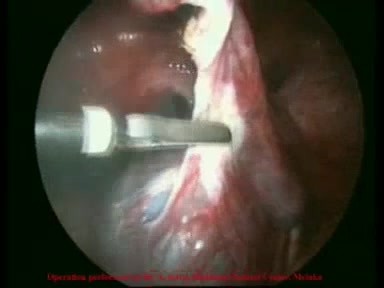 Traitement laparoscopique d'un kyste ovarien