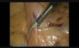 Dissection laparoscopique et l'exposition de l'artère mésentérique inférieure en chirurgie colo-rectale à cause du cancer