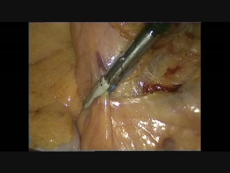 Dissection laparoscopique et l'exposition de l'artère mésentérique inférieure en chirurgie colo-rectale à cause du cancer