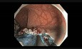 Coloscopie - Rectum - Tumeur à Extension Latérale Granulaire - EMR partie II