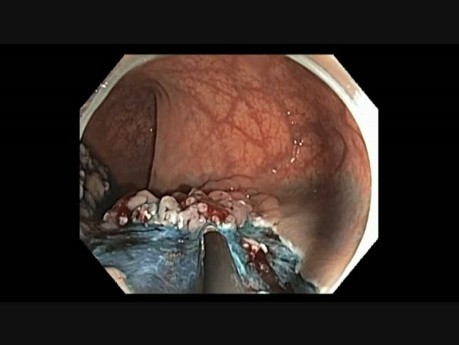 Coloscopie - Rectum - Tumeur à Extension Latérale Granulaire - EMR partie II