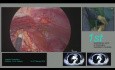 Thymomectomie sous-xiphoïde et thymectomie par chirurgie thoracique vidéo-assistée (CTVA) par incision unique