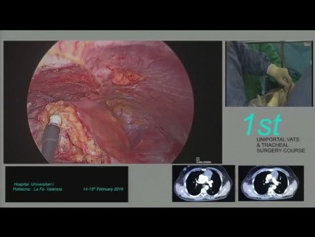 Thymomectomie sous-xiphoïde et thymectomie par chirurgie thoracique vidéo-assistée (CTVA) par incision unique