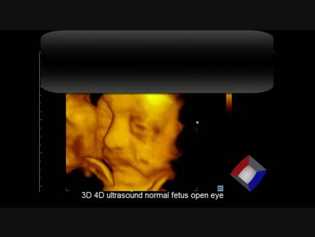 Échographie normale 3D-4D du fœtus qui ouvre les yeux