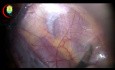 Anatomie Laparoscopique de Hernie Inguinale