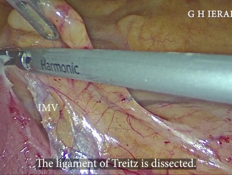 Hémicolectomie gauche par laparoscopie pour le cancer de l'angle colique gauche avec préservation de l'artère mésentérique inférieure (AMI): notre technique étape par étape