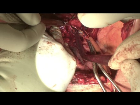 Patch de Xénogreffe d'Artère Pulmonaire dans une Lobectomie Supérieure Gauche à Double Manchon pour CPNPC