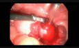 Salpingostomie laparoscopique due à la GEU