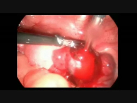 Salpingostomie laparoscopique due à la GEU