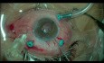 Technique Yamane - Méthode de Fixation par Lentille Transsclérale