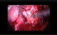 Kystectomie (Kyste Endometriosique bilatéral, pelvis adhérentiel)