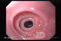 L'anneau de Schatzki -  évaluation endoscopique de l'œsophage, partie 1