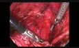 Rectopexie antérieure avec utilisation d'une prothèse synthétique par voie laparoscopique