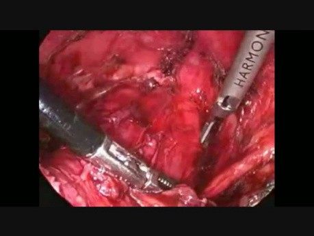 Rectopexie antérieure avec utilisation d'une prothèse synthétique par voie laparoscopique