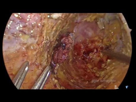 Prise en Charge Mini-Invasive des Lésions de la Veine Iliaque pour Cancer Rectal Localement Avancé