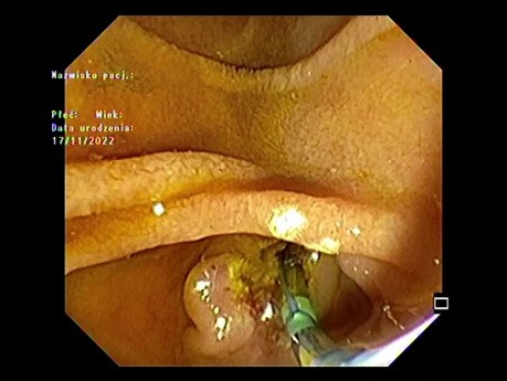 Extraction de Calcul du Cholédoque